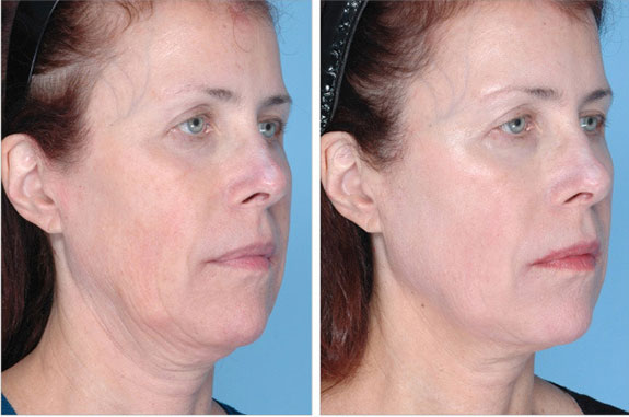 Before And After Photos Mountain View - Ultherapy Image 36