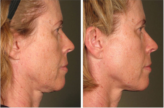 Before And After Photos Mountain View - Ultherapy Image 35