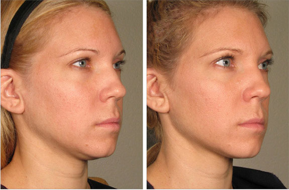 Before And After Photos Mountain View - Ultherapy Image 34