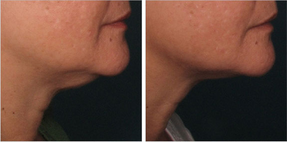 Before And After Photos Mountain View - Ultherapy - Lower Face Image 01