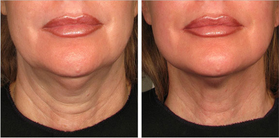Before And After Photos Mountain View - Ultherapy - Lower Face Image 10