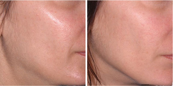 Before And After Photos Mountain View - Ultherapy - Lower Face Image 11