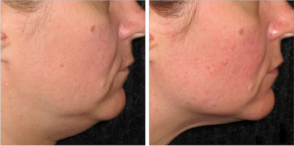 Before And After Photos Mountain View - Ultherapy - Lower Face Image 12