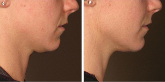 Before And After Photos Mountain View - Ultherapy - Lower Face Image 02