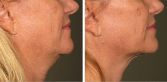 Before And After Photos Mountain View - Ultherapy - Lower Face Image 03