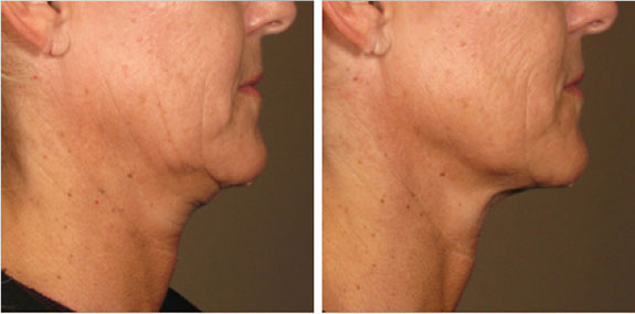 Before And After Photos Mountain View - Ultherapy - Lower Face Image 04