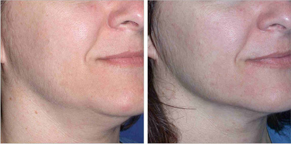 Before And After Photos Mountain View - Ultherapy - Lower Face Image 05