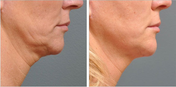 Before And After Photos Mountain View - Ultherapy - Lower Face Image 07