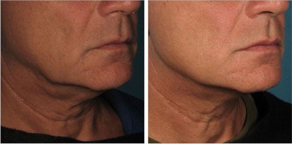 Before And After Photos Mountain View - Ultherapy - Lower Face Image 09