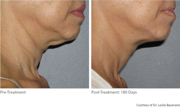 Before And After Photos Mountain View - Ultherapy Image 11