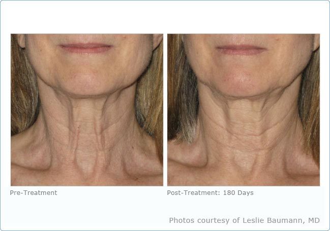Before And After Photos Mountain View - Ultherapy Image 01