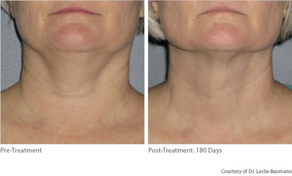Before And After Photos Mountain View - Ultherapy Image 09