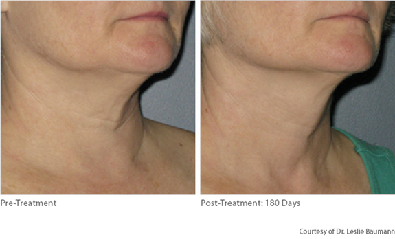 Before And After Photos Mountain View - Ultherapy Image 08