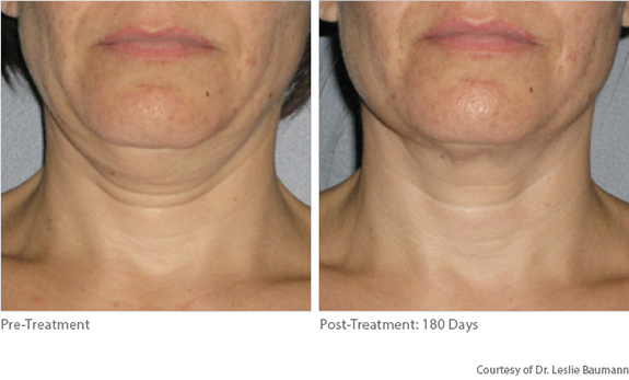 Before And After Photos Mountain View - Ultherapy Image 07