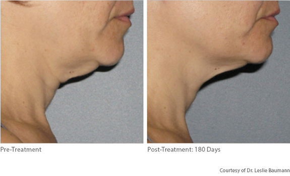 Before And After Photos Mountain View - Ultherapy Image 06