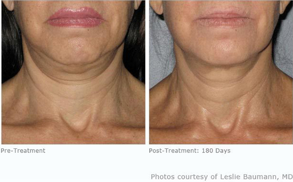Before And After Photos Mountain View - Ultherapy Image 05