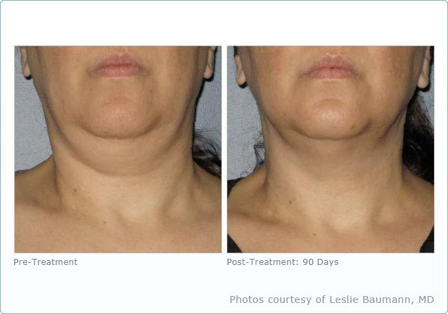 Before And After Photos Mountain View - Ultherapy Image 04
