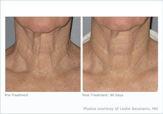 Before And After Photos Mountain View - Ultherapy Image 03