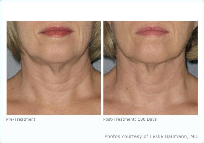 Before And After Photos Mountain View - Ultherapy Image 02