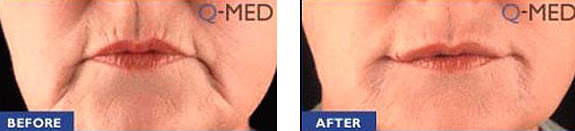 Before And After Photos Mountain View - Wrinkle Fillers Image 01