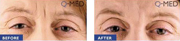Before And After Photos Mountain View - Wrinkle Fillers Image 10