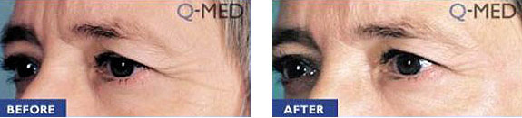 Before And After Photos Mountain View - Wrinkle Fillers Image 11