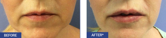 Before And After Photos Mountain View - Wrinkle Fillers Image 12