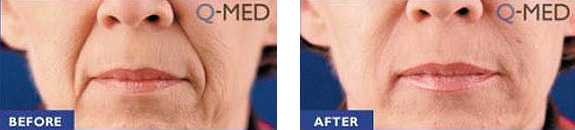 Before And After Photos Mountain View - Wrinkle Fillers Image 02