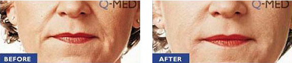 Before And After Photos Mountain View - Wrinkle Fillers Image 04