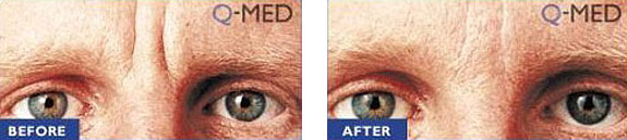 Before And After Photos Mountain View - Wrinkle Fillers Image 09