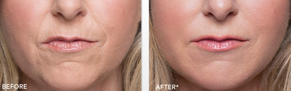 Before And After Photos Wrinkles and Fine Lines - Sculptra Image 01