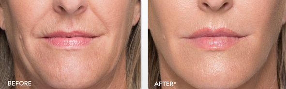 Before And After Photos Wrinkles and Fine Lines - Sculptra Image 02