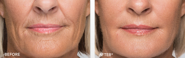 Before And After Photos Wrinkles and Fine Lines - Sculptra Image 03