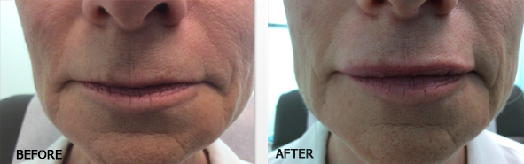 Before And After Photos Wrinkles and Fine Lines - Sculptra Image 06
