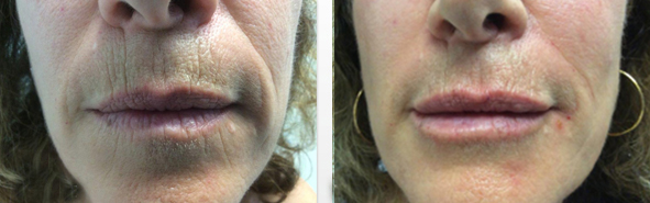 Before And After Photos Wrinkles and Fine Lines - Sculptra Image 08