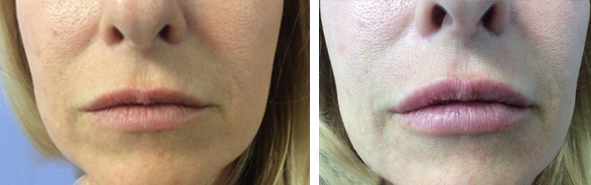 Before And After Photos Wrinkles and Fine Lines - Sculptra Image 09