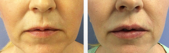 Before And After Photos Wrinkles and Fine Lines - Sculptra Image 10