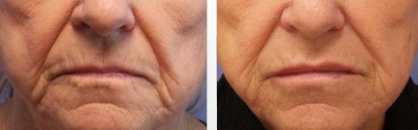 Before And After Photos Wrinkles and Fine Lines - Sculptra Image 11