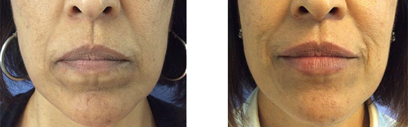 Before And After Photos Wrinkles and Fine Lines - Sculptra Image 12