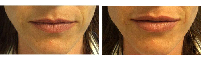 Before And After Photos Wrinkles and Fine Lines - Sculptra Image 14