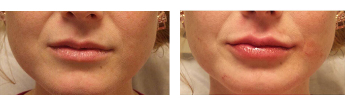 Before And After Photos Wrinkles and Fine Lines - Sculptra Image 15