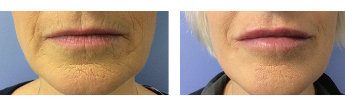 Before And After Photos Wrinkles and Fine Lines - Sculptra Image 16