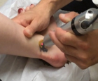 dermatology procedure video gallery mountain view - PicoWay Laser Tattoo Removal (First Treatment) Patient 1