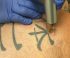 dermatology procedure video gallery mountain view - PicoWay Laser Tattoo Removal (First Treatment) Patient 2