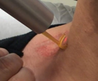 dermatology procedure video gallery mountain view - PicoWay Laser Tattoo Removal (First Treatment) Patient 3