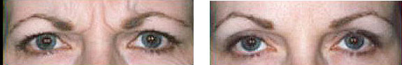 Before And After Photos Mountain View - BOTOX® / Dysport® / Xeomin® Image 02