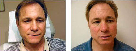 Before And After Photos Mountain View - Chemical Peels Image 12