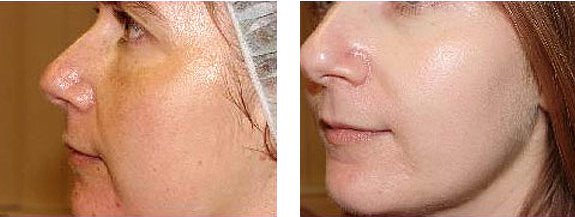 Before And After Photos Mountain View - Chemical Peels Image 02