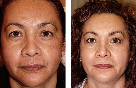 Before And After Photos Mountain View - Chemical Peels Image 05