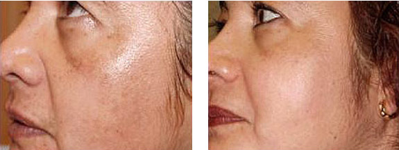 Before And After Photos Mountain View - Chemical Peels Image 07